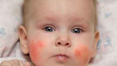 الطفح الجلدي عند الأطفال