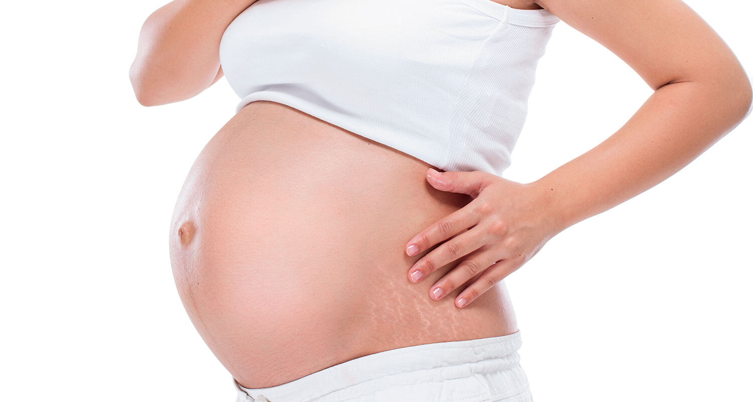علامات التمدد خلال الحمل